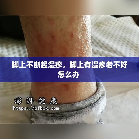 腳上不斷起濕疹，腳上有濕疹老不好怎么辦 