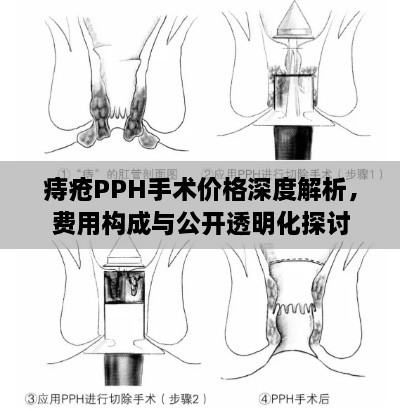 痔瘡PPH手術(shù)價(jià)格深度解析，費(fèi)用構(gòu)成與公開透明化探討